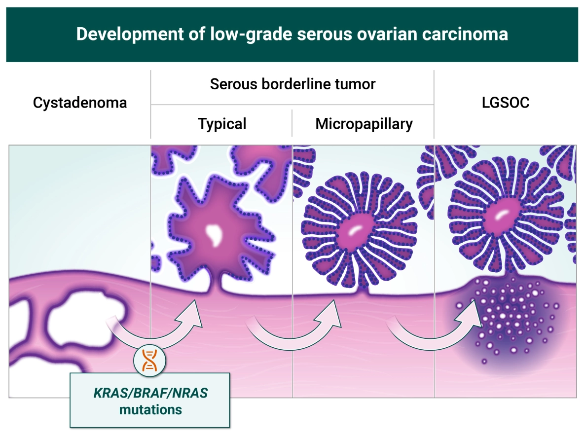 Graphical representation of development of low-grade serous ovarian carcinoma