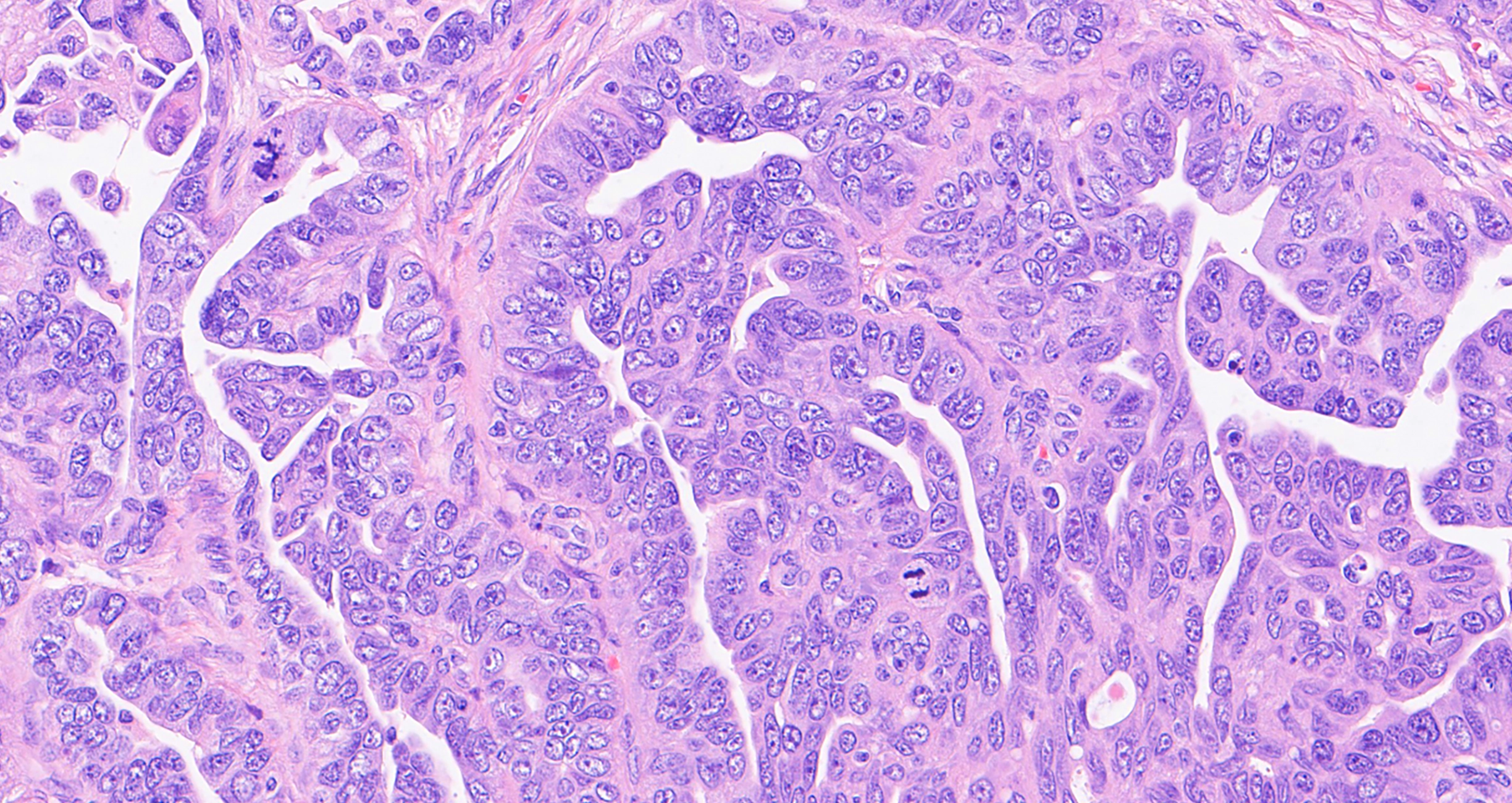 High-grade serous ovarian cancer cells