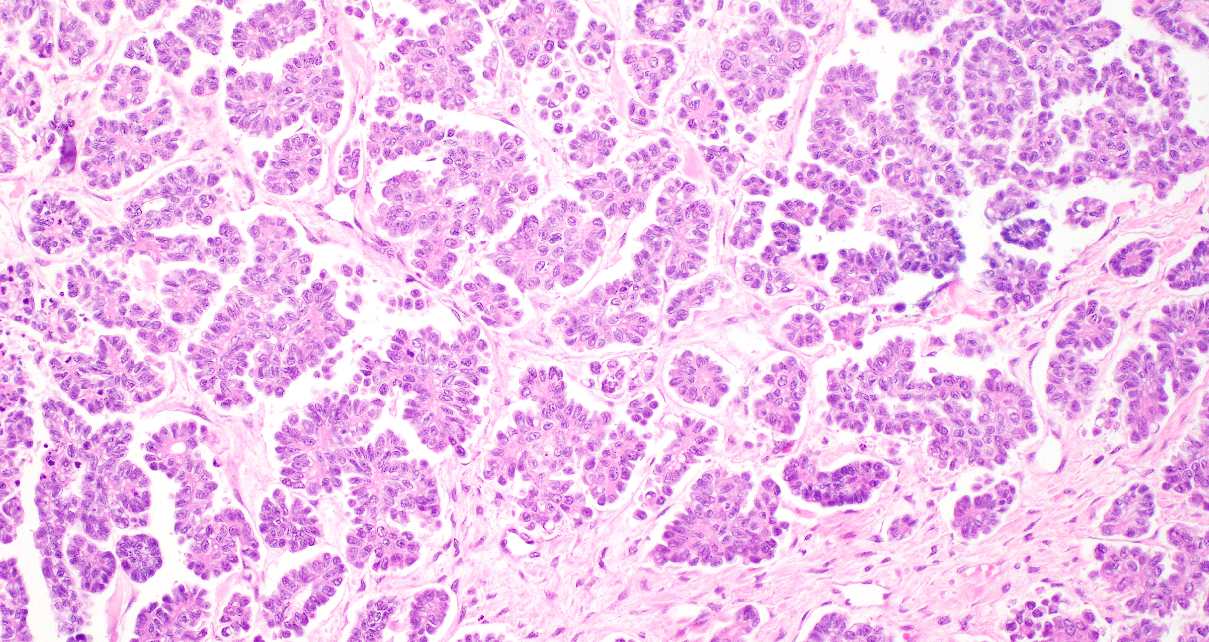 Low-grade serous ovarian cancer cells